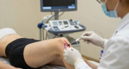 For Chronic Knee Pain, Genicular Artery Embolization Provides a New Alternative